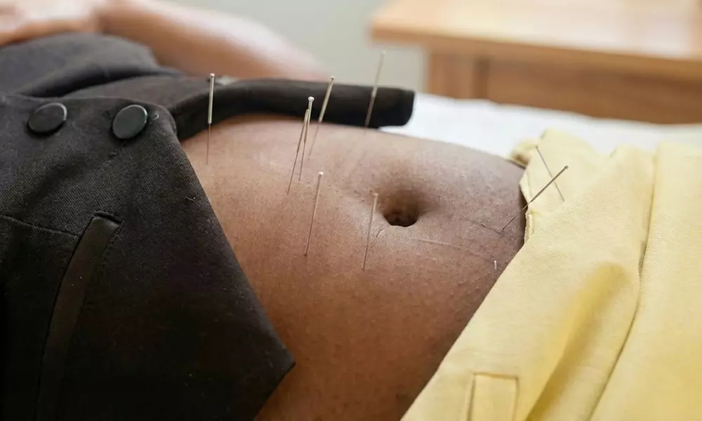 Yoo Balance Therapy & Wellness Offers 1, 3, or 5 Sessions of Acupuncture for Holistic Wellness (Up to 60% Off) - Second Medium