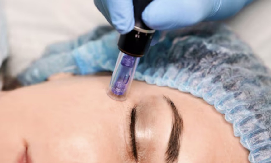 Image 1: Revitalize with Microneedling, Hyaluronate Serum and LED Light Therapy