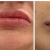 Image 4: 1ml or 2ml Dermal Filler Treatment on Lips with Consultation