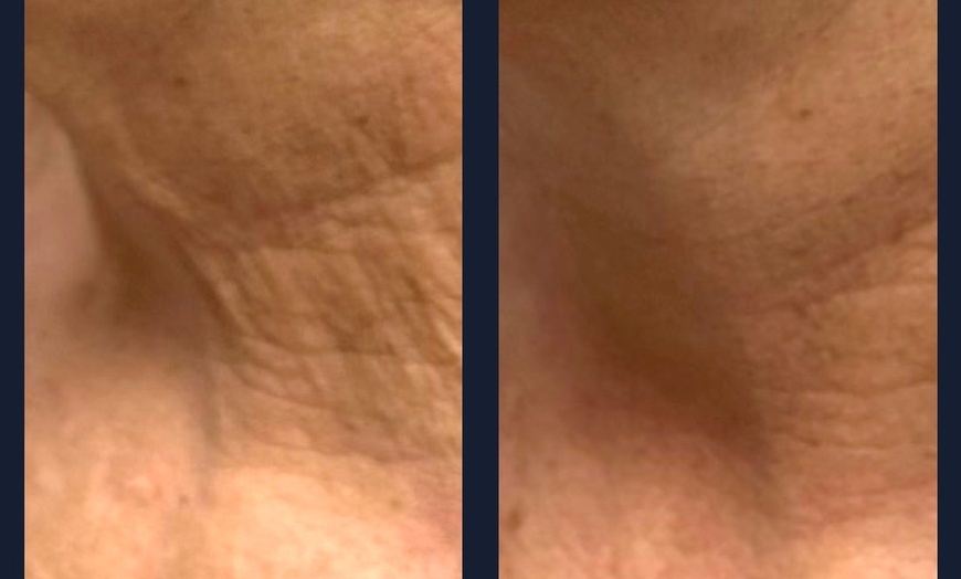 Image 5: Intro Cryo Slimming or 4 or 6 Cryo Contour Sessions
