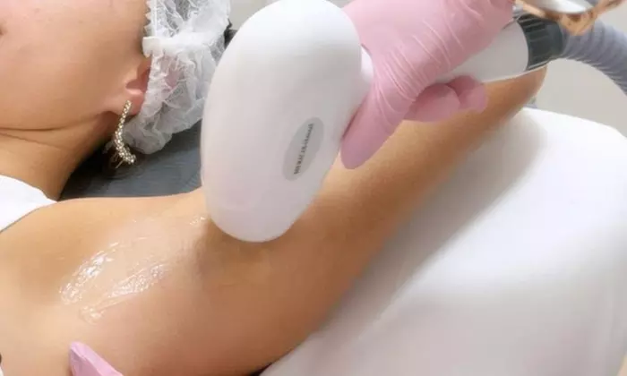 Depilación láser, peeling Hollywood y láser de picosegundos en Tellamor con hasta un 77% de descuento - Primary Image