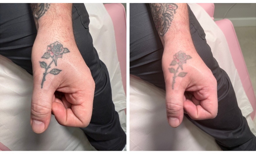 Image 2: Three or Six Laser Tattoo Removal Session w/ Consultation & Patch Test