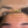 Image 5: Botox Units for Forehead Lines Crow Feet and Full Face Smoothing