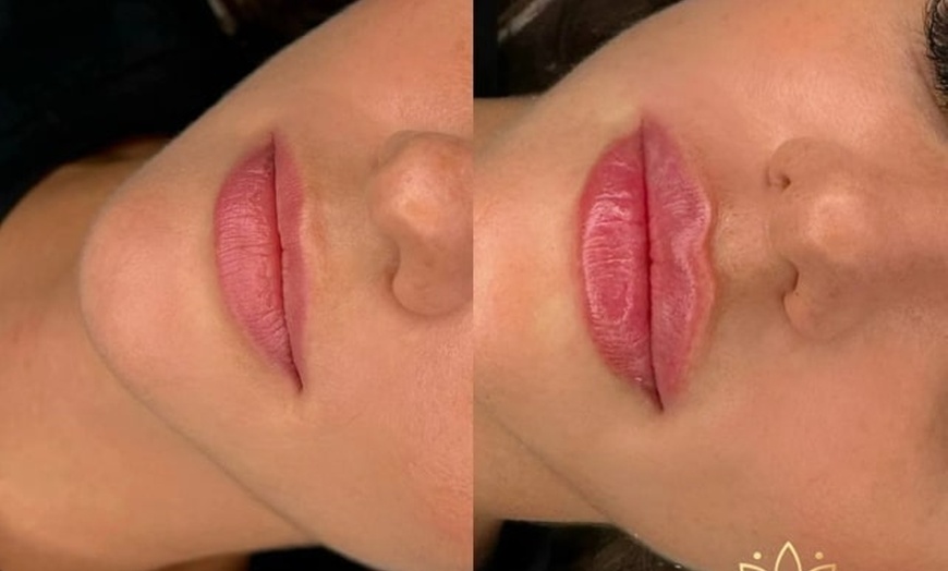 Image 6: Get a Dermal Filler Today: 1ml or 2ml Lips
