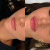 Image 6: Get a Dermal Filler Today: 1ml or 2ml Lips