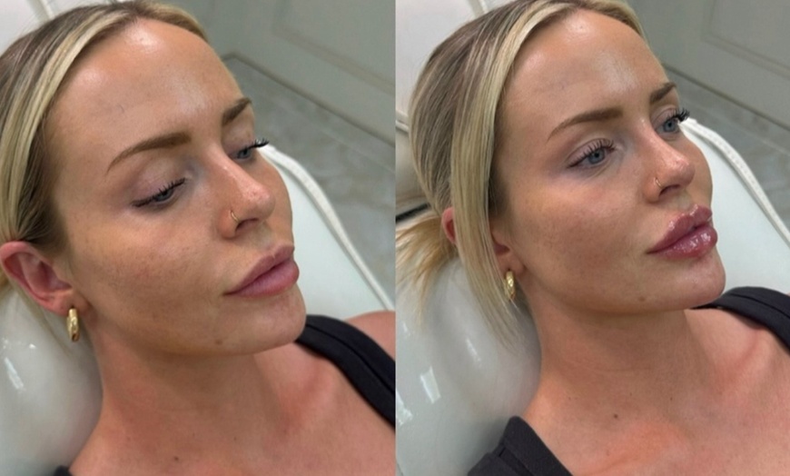 Image 2: Boost Hair and Skin Health with PRP Facial