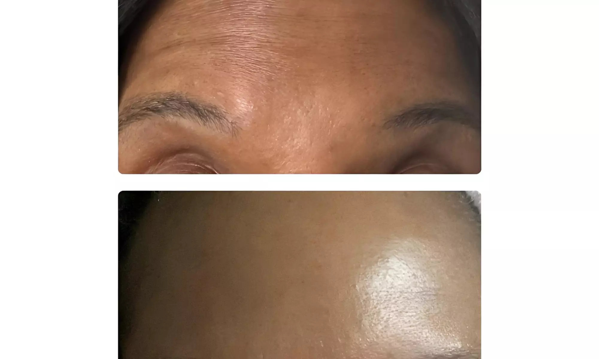 Choose From 0.5ml, 1ml, or 3ml Dermal Filler Syringes