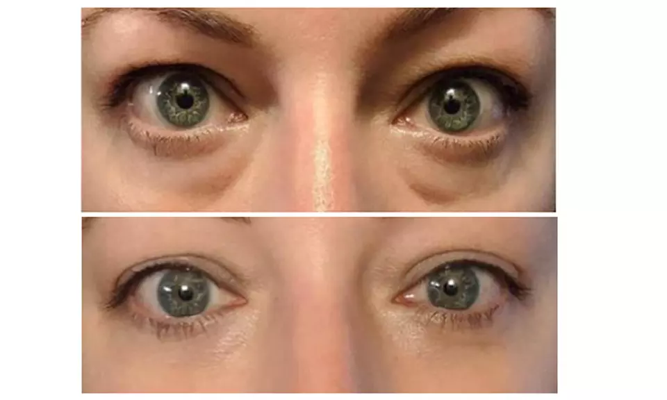 Advanced Skin Regeneration with 1,2,or 3 Sessions of Polynucleotide