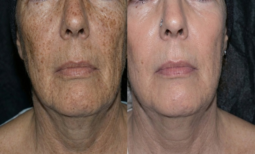 Image 4: Boost Collagen with 2 CC, 3 CC, 4 CC, or 5 CC of Sculptra Injections