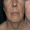 Image 4: Boost Collagen with 2 CC, 3 CC, 4 CC, or 5 CC of Sculptra Injections