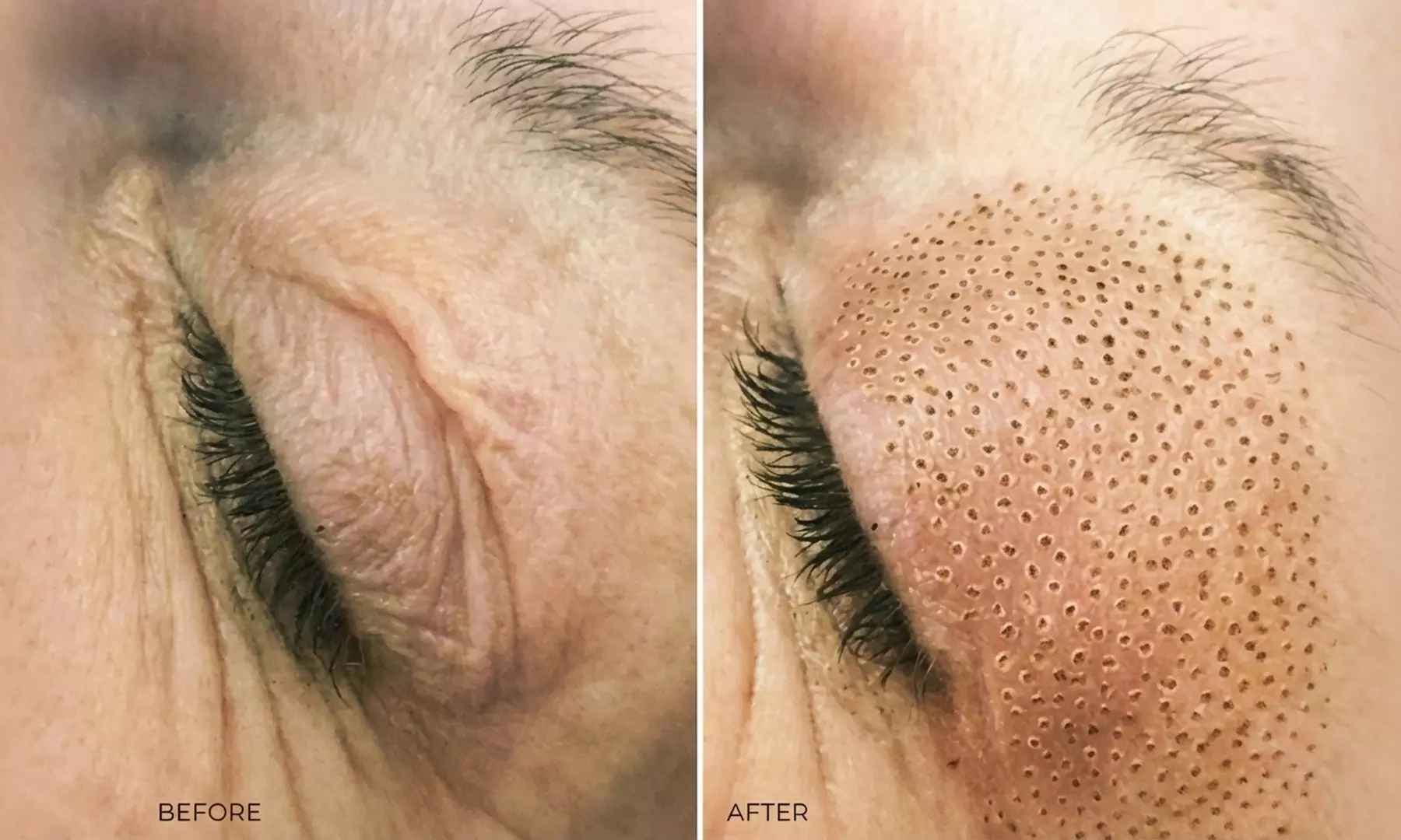 1 o 2 sesiones de plasma pen en zona a elegir para 1 persona