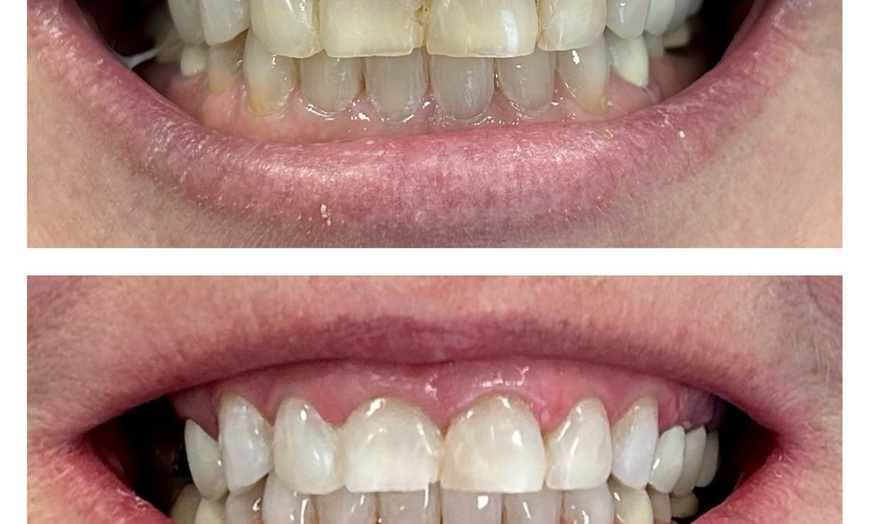 Image 4: Get a Brighter Smile with Phillips Zoom Whitening! Teeth Whitening