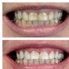 Image 4: Get a Brighter Smile with Phillips Zoom Whitening! Teeth Whitening