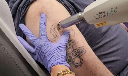 One  Laser Tattoo Removal Session on a Small Area(dollar coin) - Artem Med Spa