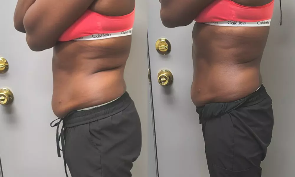 Body Contouring Sessions & Packages – Single, Multi-Session, or Duo