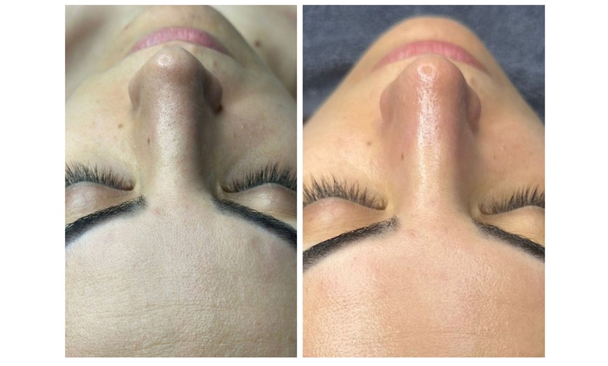 Image 5: Hydra Glow Hollywood Skin Care - Deluxe or Classic, or Mini Facial