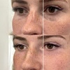 Image 1: Refresh Your Look with Profhilo® Sessions at Aesthetic Zone