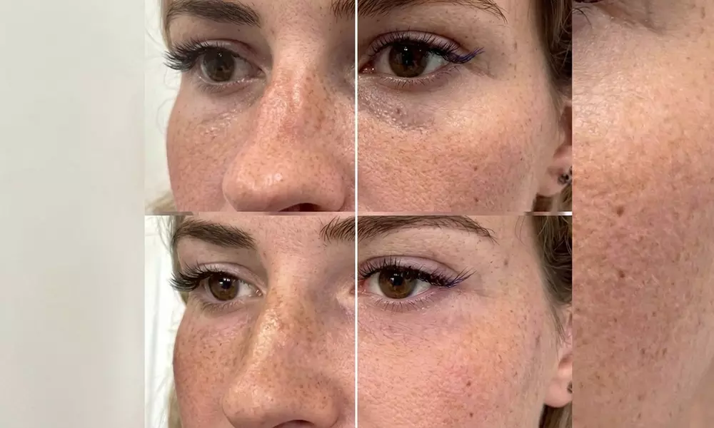 Experience Aesthetic Zone's Two Profhilo® Sessions for Skin Hydration (Up To 64% Off) - Primary Image