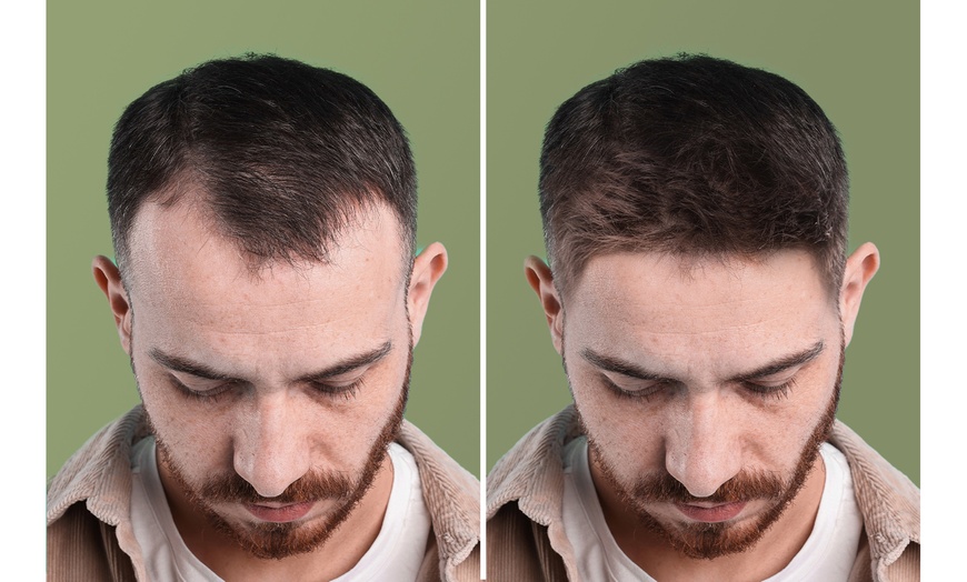 Image 3: 30-Day Finasteride Prescription Hair Growth Program with Consultation