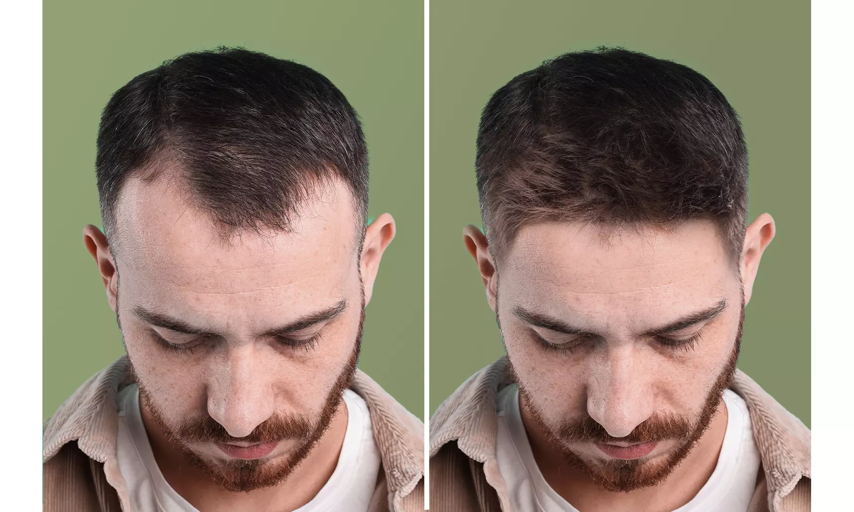 Hair Growth 1 month (30 tablet) Program –  Finasteride or Minoxidil