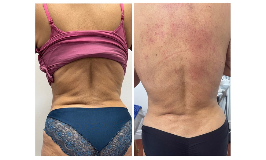 Image 6: One, Two or Three Sessions of Radio-Frequency Skin Tightening