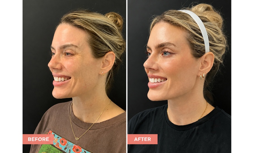 Image 4: Youthful Confidence Awaits with 20, 40, or 60 Units of Botox Treatment