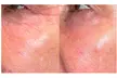 Morpheus 8 Face & Neck Or Abdomen/Butt Skin Tightening Treatment at Skin Dealer (Up to 50% Off) - Second Medium