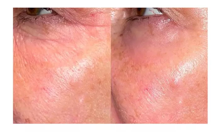 Up to 77% Off on Radio Frequency Skin Tightening