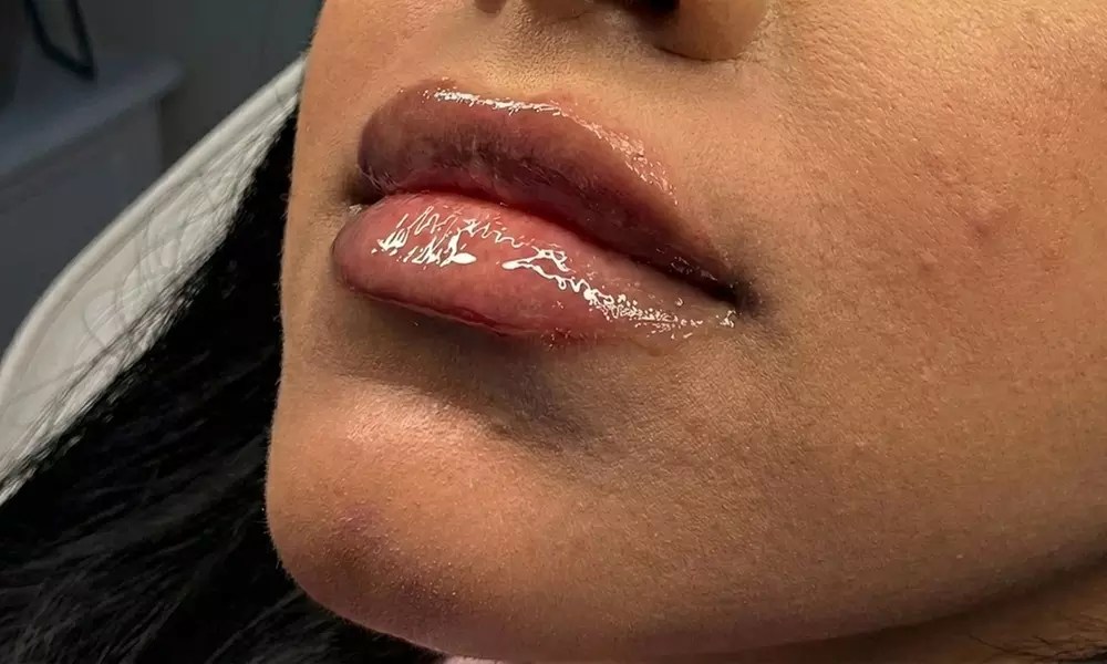 Achieve Natural-Looking Fullness with Half Syringe Restylane Kysse Lip Filler & Free Consultation(Up to 30% Off) - Second Medium