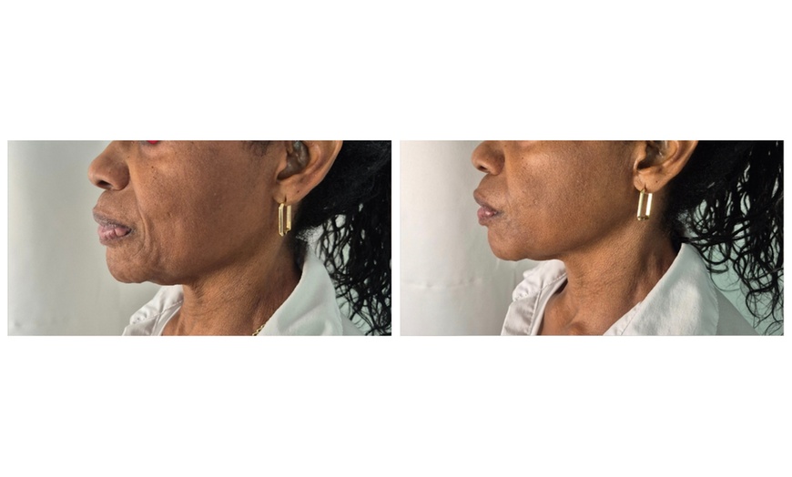 Image 2: Get 1, 3, or 6(60 Min) Ultrasonic Cavitation, RF & Laser Lipo Sessions