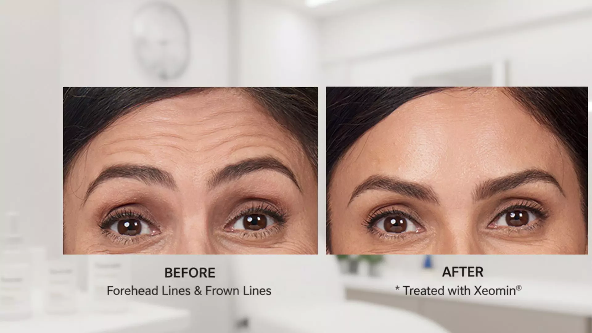 Smooth Away Fine Lines and Wrinkles with Xeomin at Half the Price! - Primary Image