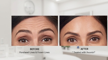 20 Units of Xeomin Injection - Luxeglow