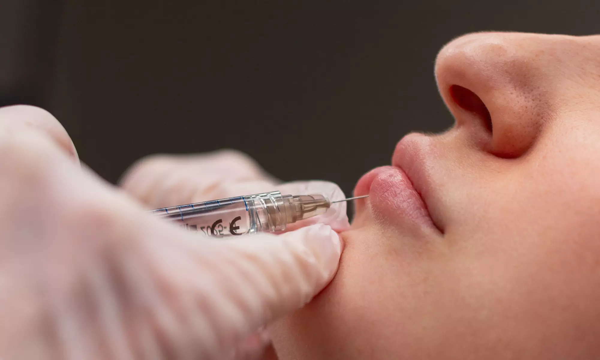 Enhance Your Lips with Half or One Syringe of Versa Lip Filler (Up to 35% Off)