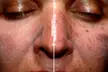 Glow Your Skin with One, Three or Five 60 Min Chemical Peel Facials at The Skin Studio (Up to 70%Off) - Second Medium