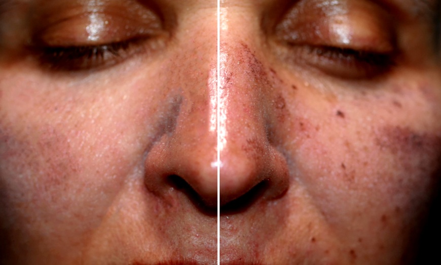 Image 3: Enhance Your Skin with One, Three or Five 60 Min Chemical Peel Facials