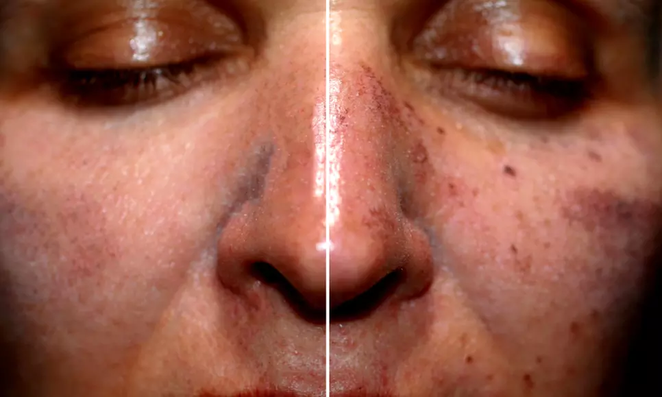 Enhance Your Skin with One, Three or Five 60 Min Chemical Peel Facials