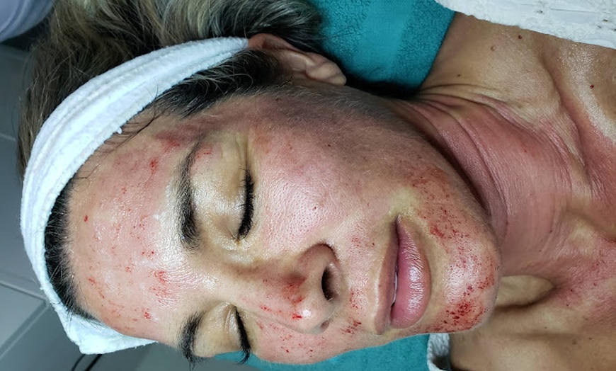 Image 3: Experience rejuvenation with PRP facial treatments