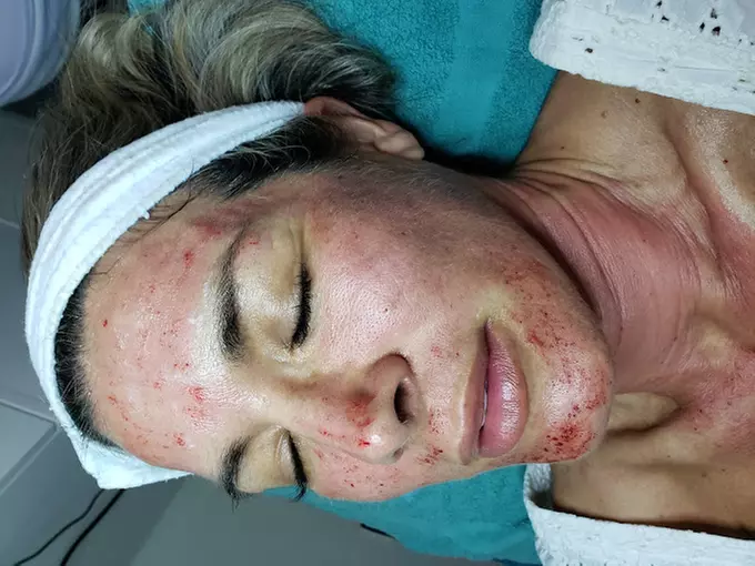 Experience rejuvenation with PRP facial treatments