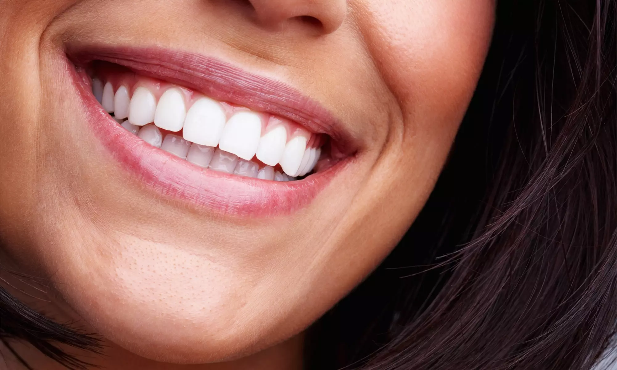 Mini-Laser or Lux Pro Teeth Whitening with One or Two Treatments