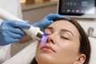 Radio Frequency for Facial or Body Lifting, Tightening & Redefinition - Up to 62% Off - Image 2