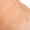 Image 1: Laser Skin Tag, Cherry Angioma, Sun Spot, Age Spot, or Milia removal