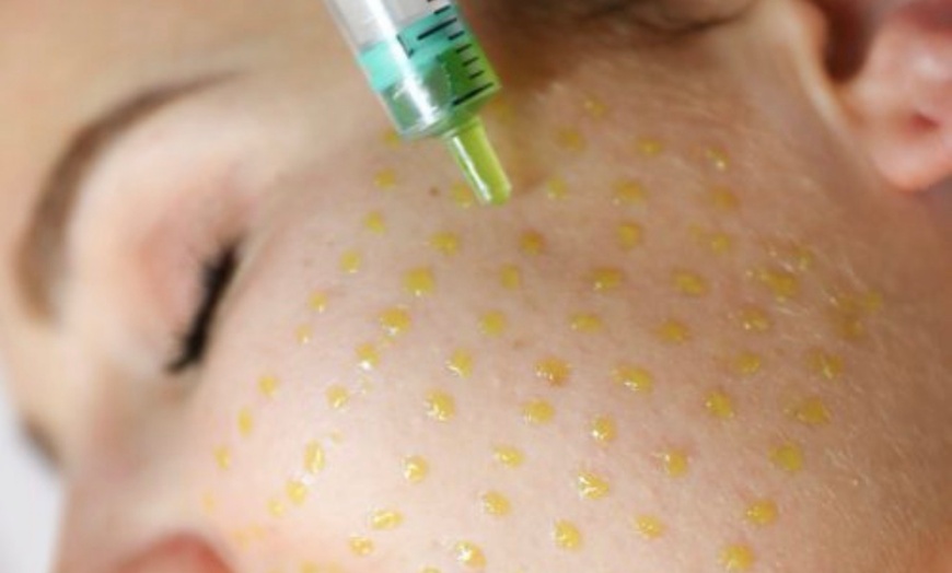 Image 2: Up to 40% Off on Chemical Peels at Mia Esthetics Med Spa
