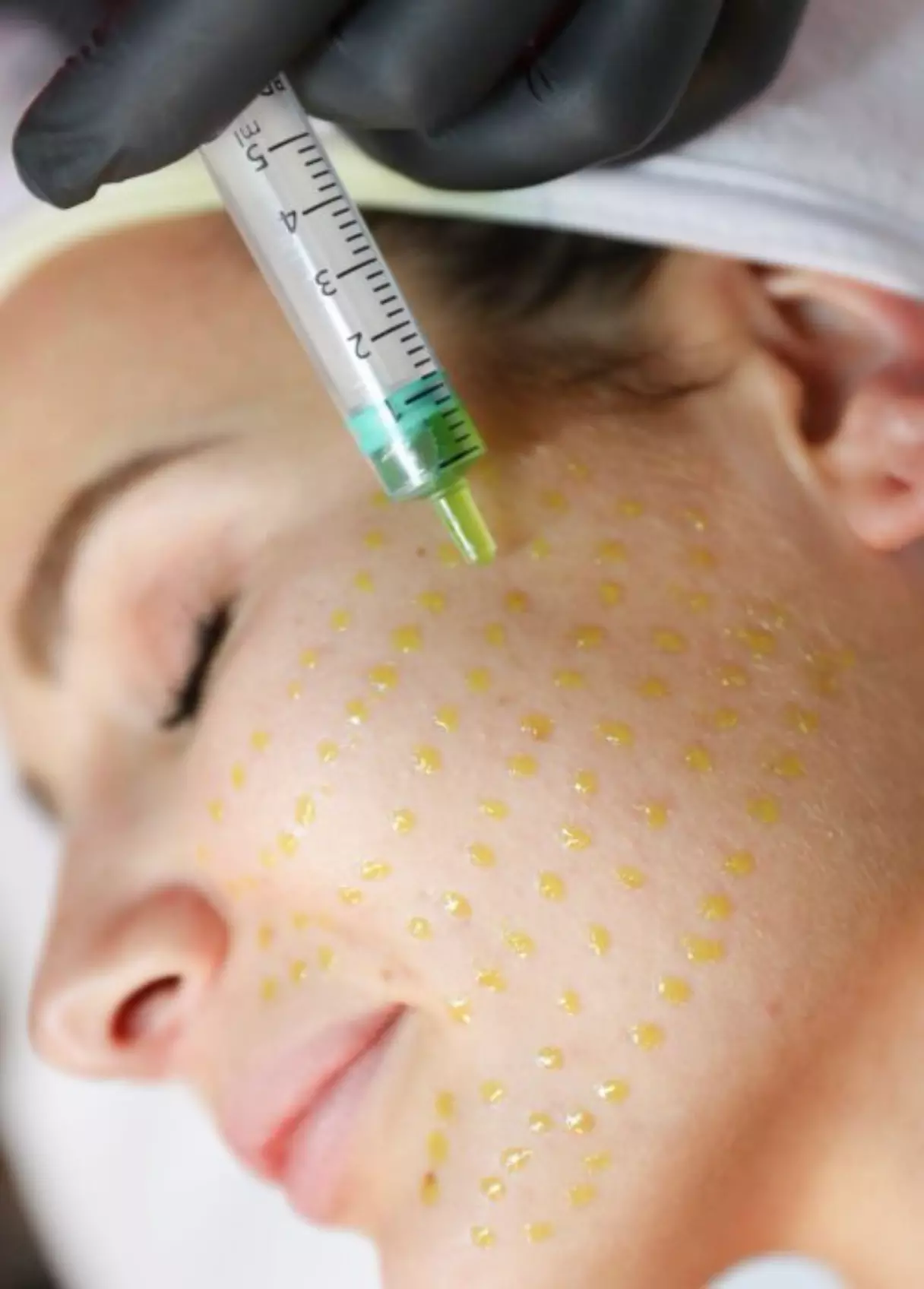 Up to 33% Off on Chemical Peels at Mia Esthetics Med Spa