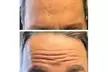 2 or 4 PDO Thread Lifts for Mid-Face/Jawline Area with One Barbed Thread/Side (Up to 49% Off) - Second Medium