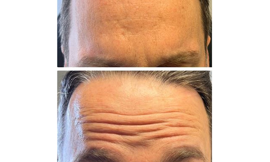 Image 5: PDO Thread Lifts for Mid-Face/Jawline Area with One Barbed Thread/Side