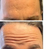 Image 5: PDO Thread Lifts for Mid-Face/Jawline Area with One Barbed Thread/Side