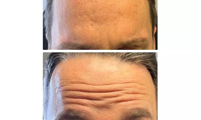 PDO Thread Lifts for Mid-Face/Jawline Area with One Barbed Thread/Side