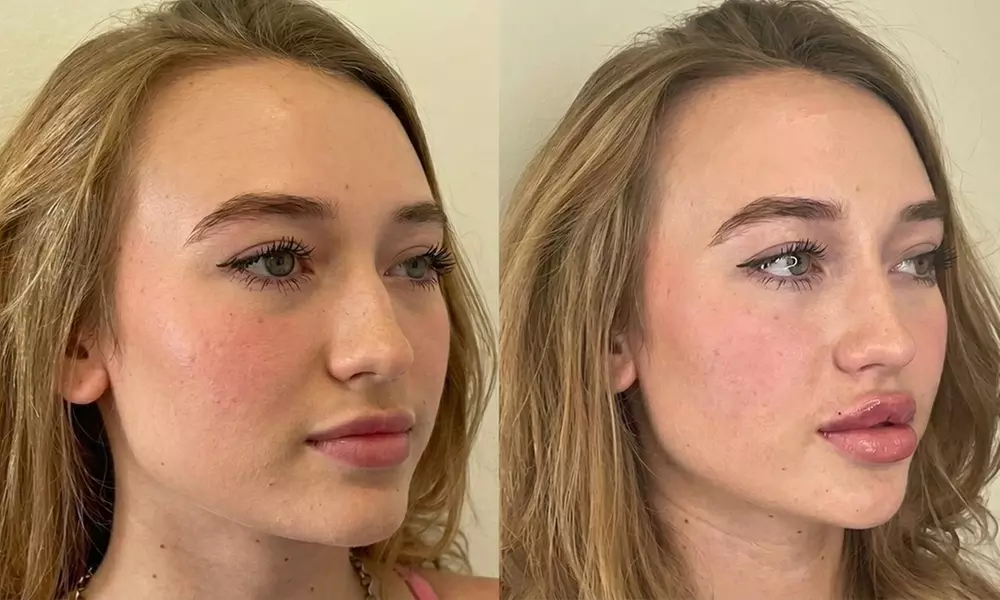 Hyaluronic Acid Lip Filler for Enhancement