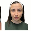 Image 2: Face-Slim – Non-Invasive Facial Fat Reduction at Your Sculpt Studio DC