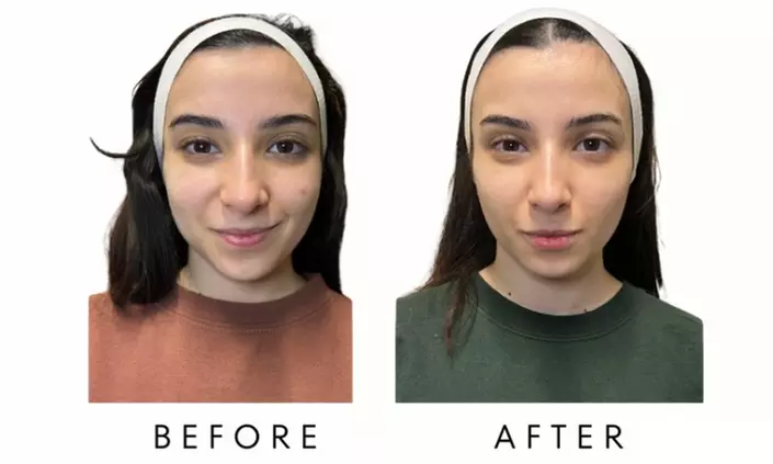 FACE-TITE - Face/Neck Tightening & Contour Lift at Your Sculpt Studio